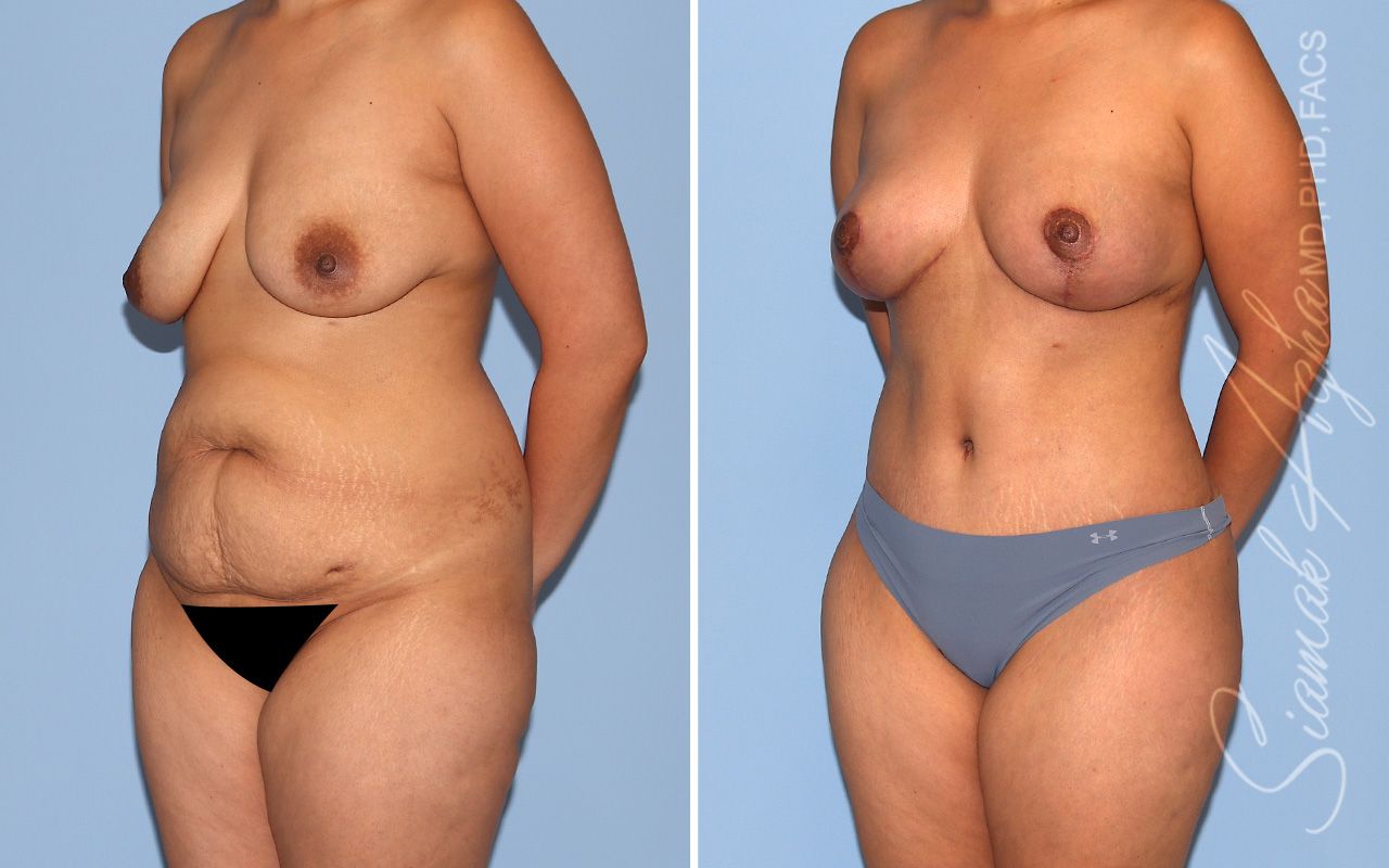 Mommy Makeover Before & After