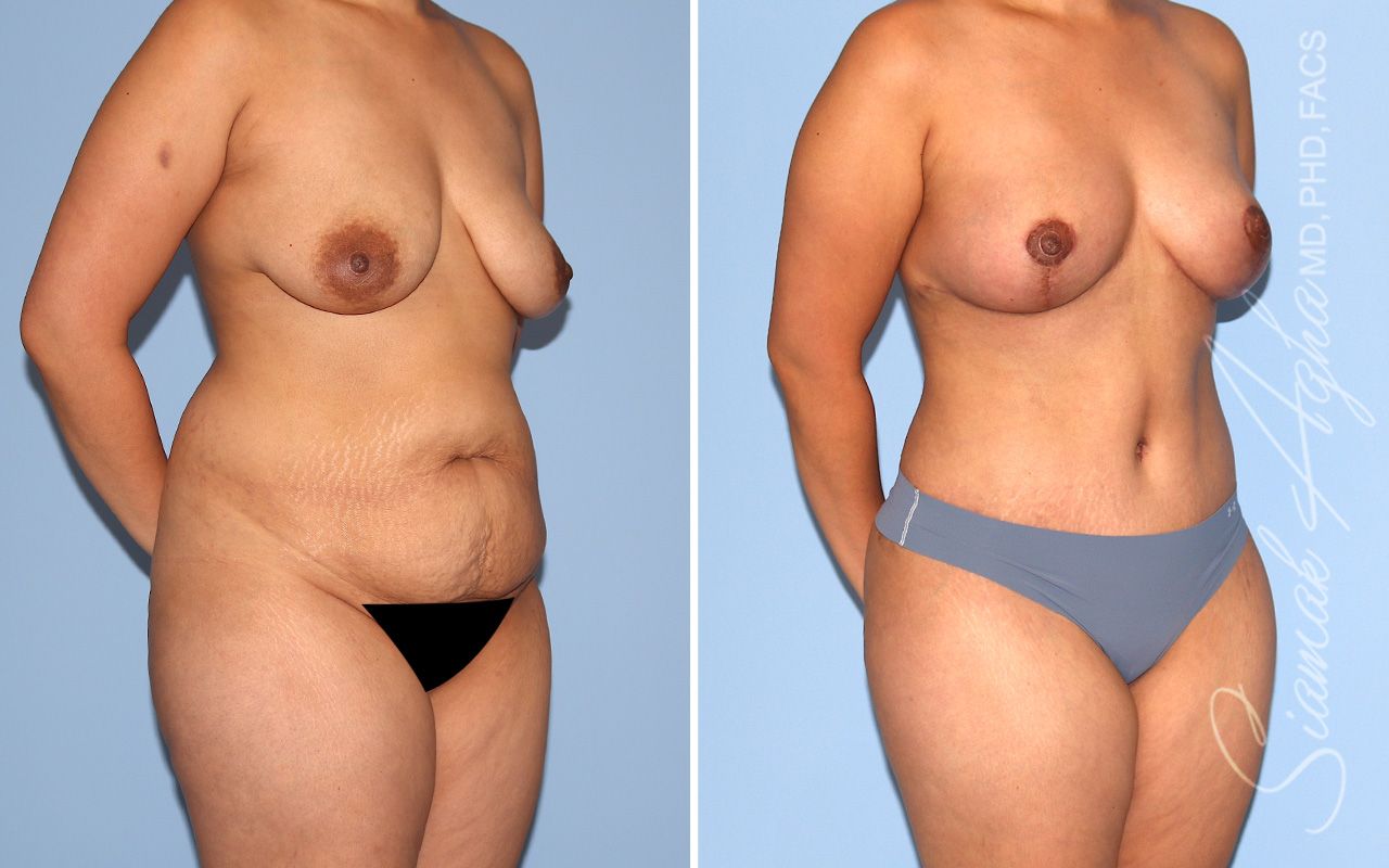 Mommy Makeover Before & After