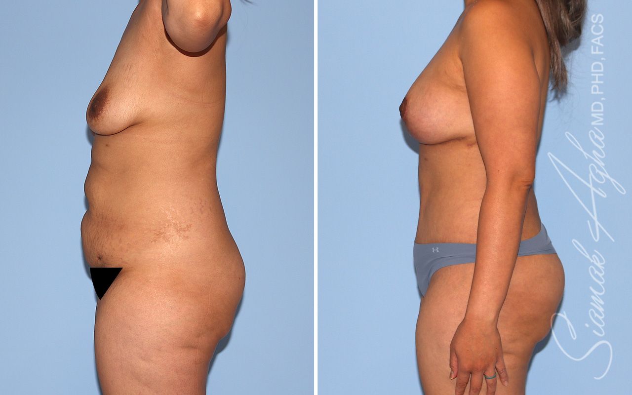 Mommy Makeover Before & After