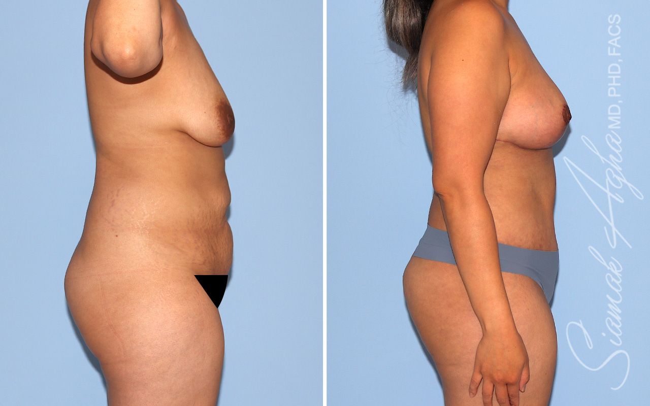 Mommy Makeover Before & After