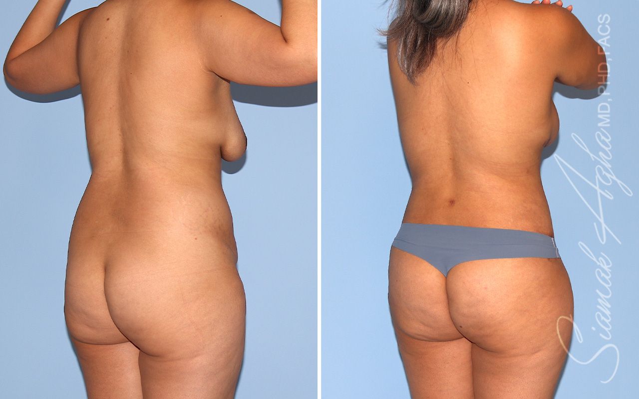 Mommy Makeover Before & After