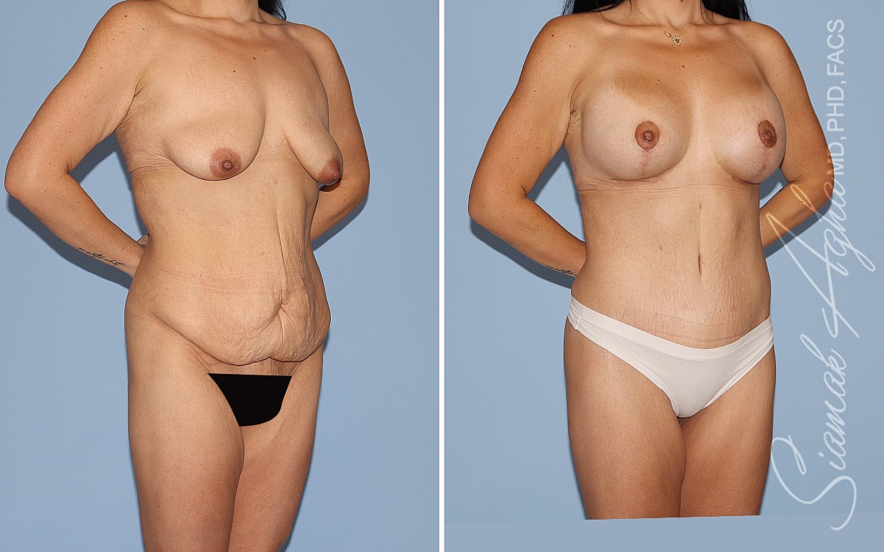 Mommy Makeover Before & After