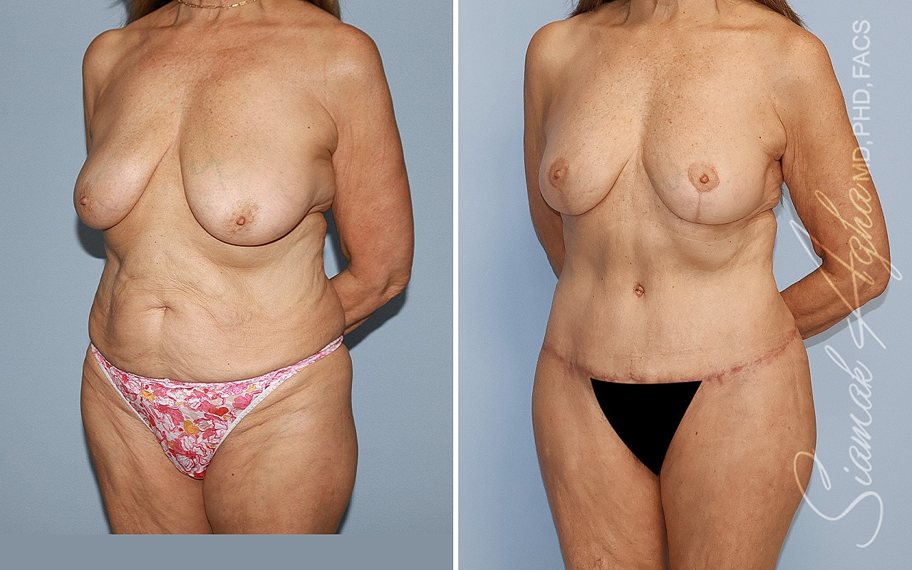 Mommy Makeover Before & After