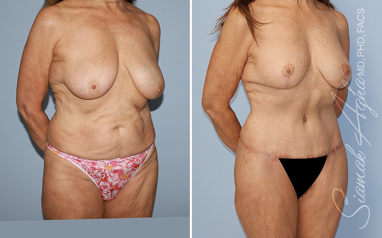 Mommy Makeover Before & After
