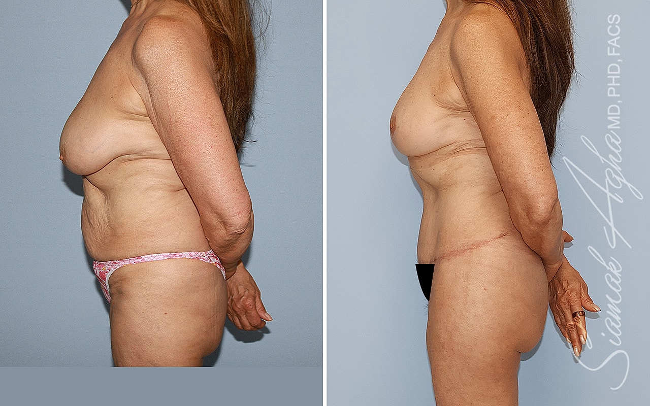 Mommy Makeover Before & After
