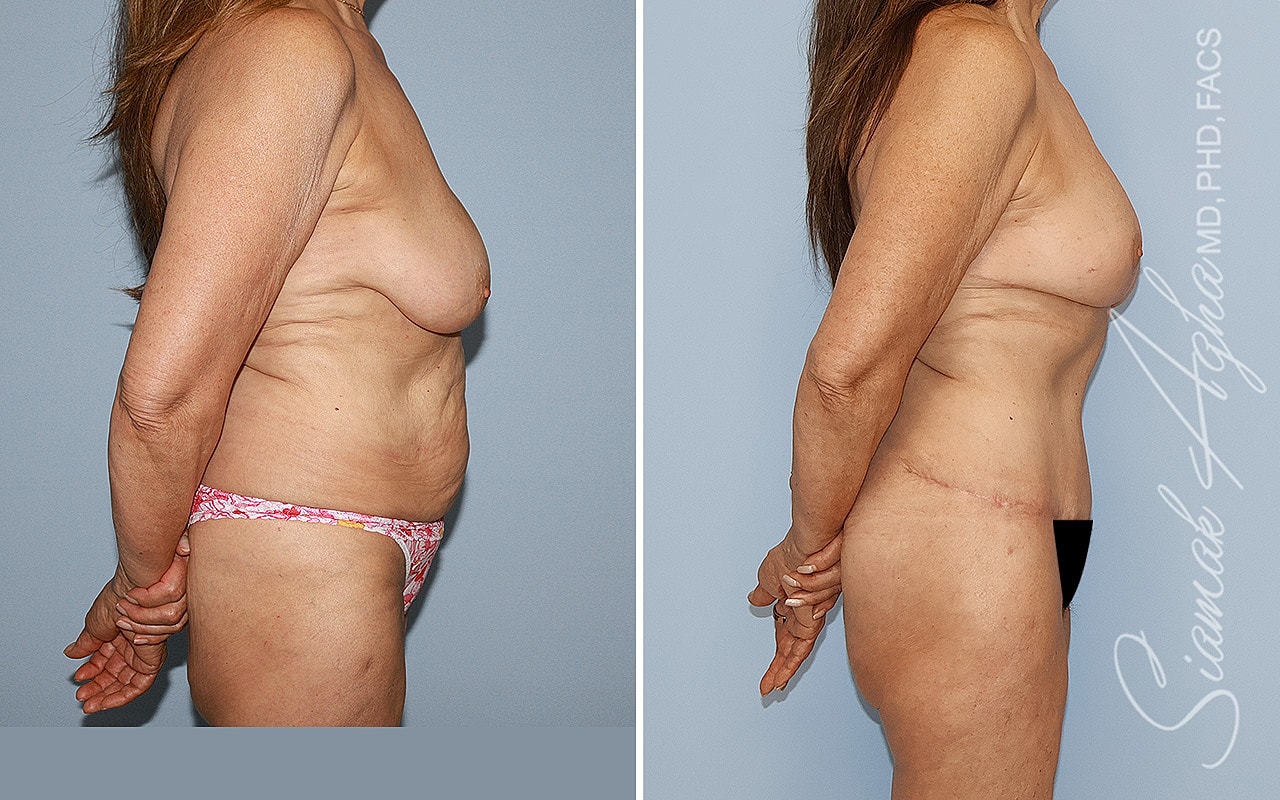 Mommy Makeover Before & After