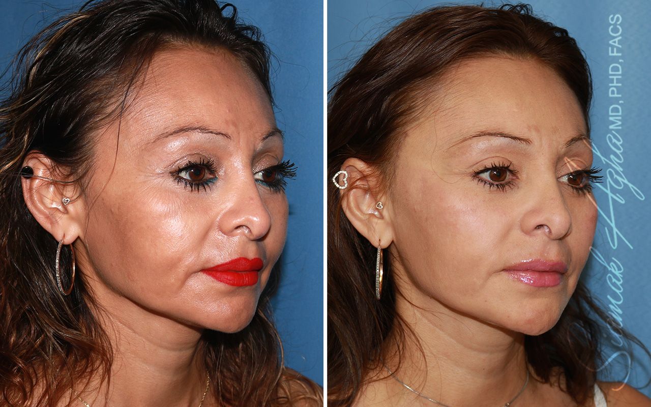 Cheek Lift Before & After