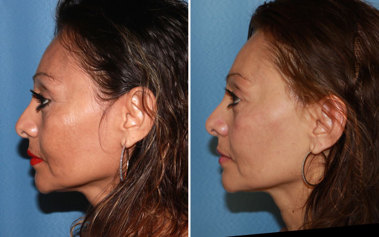 Cheek Lift Before & After