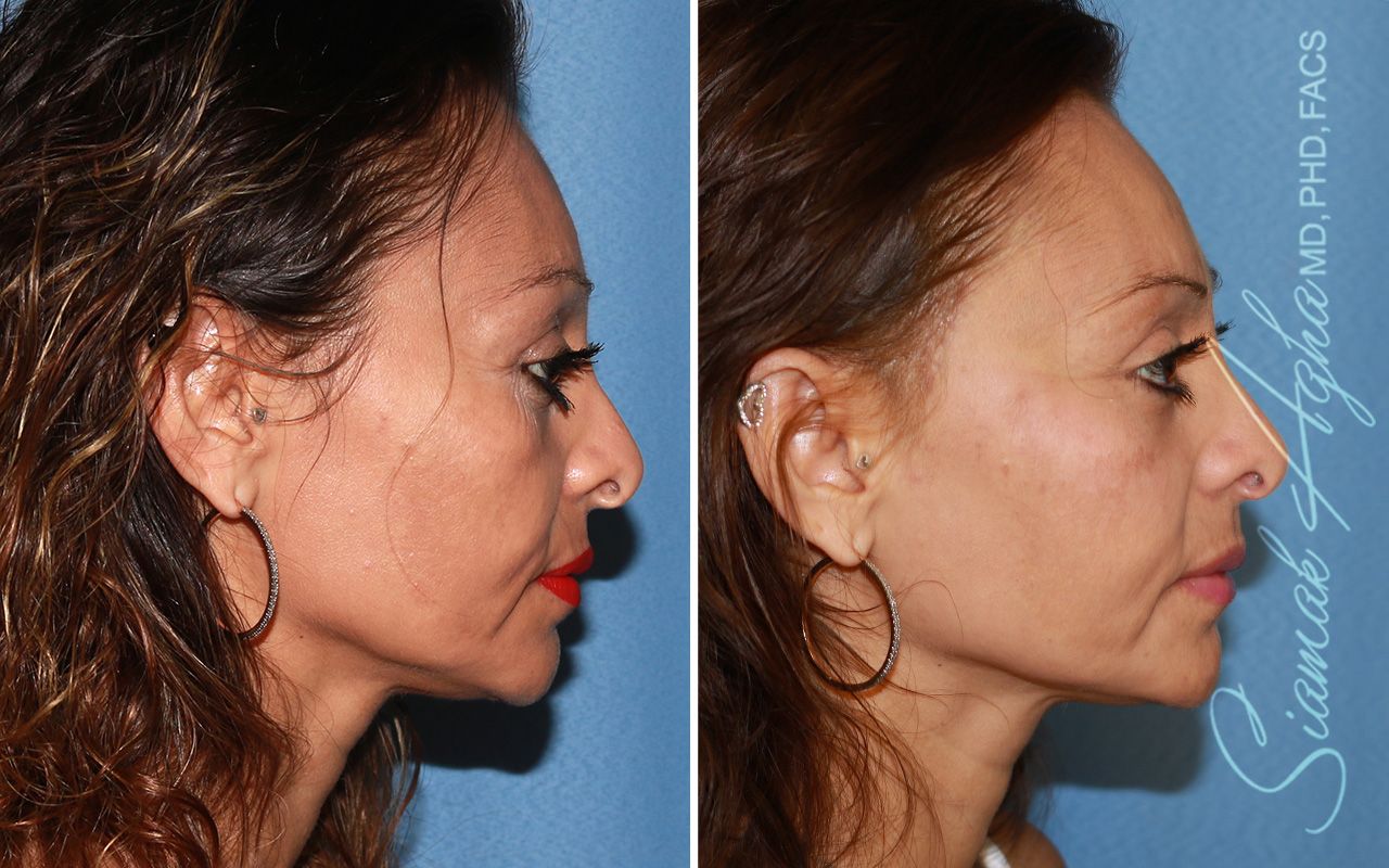Cheek Lift Before & After