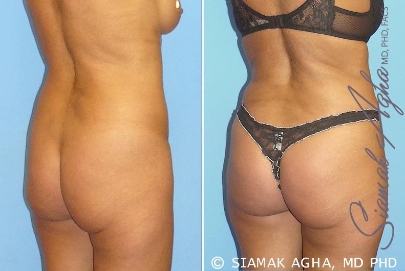 Brazilian Butt Lift Before & After