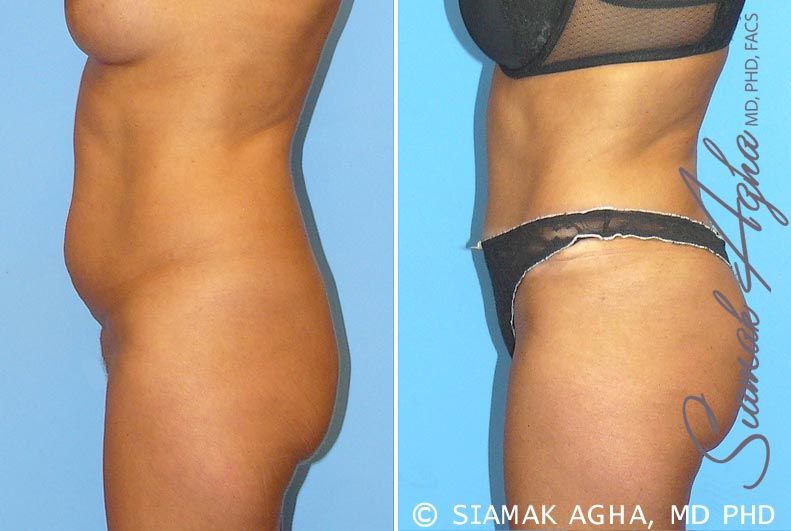 Brazilian Butt Lift Before & After