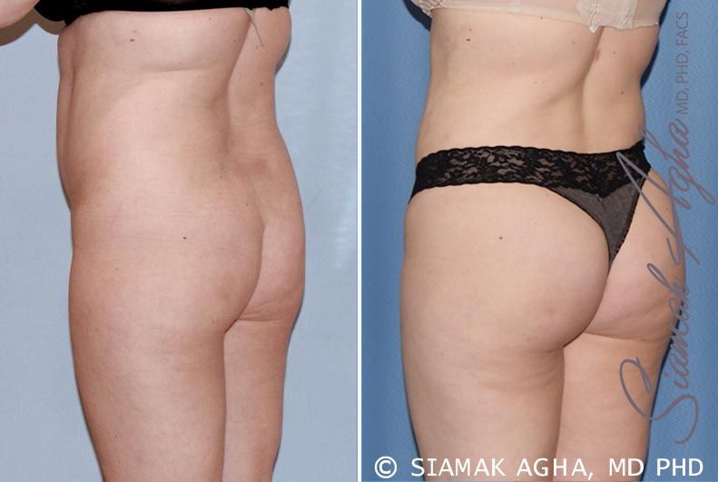 Brazilian Butt Lift Before & After