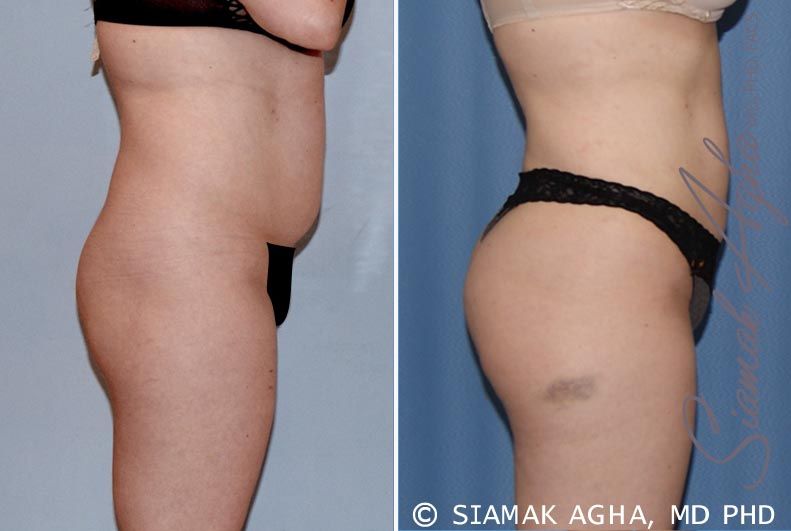 Brazilian Butt Lift Before & After