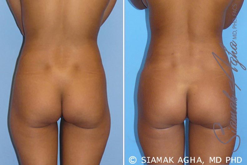 Brazilian Butt Lift Before & After