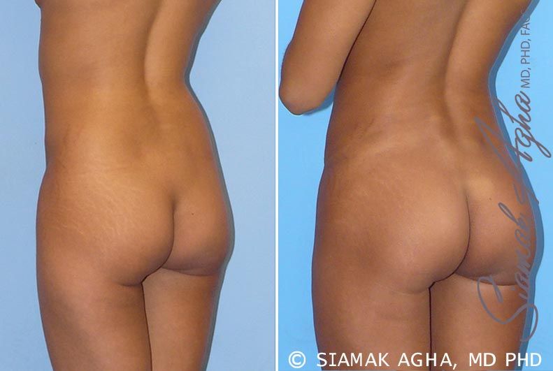 Brazilian Butt Lift Before & After