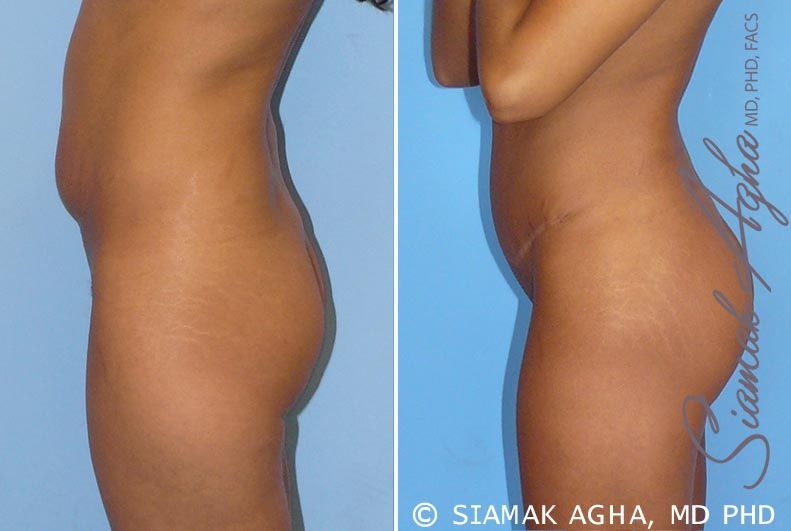 Brazilian Butt Lift Before & After