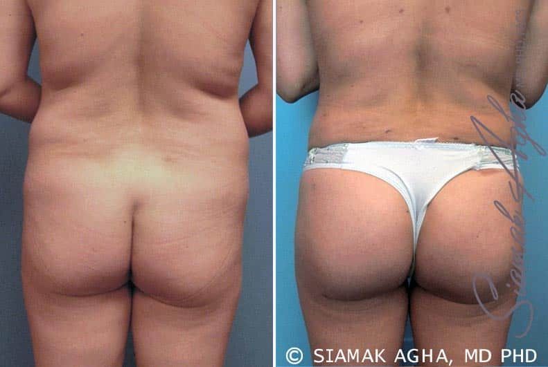 Brazilian Butt Lift Before & After
