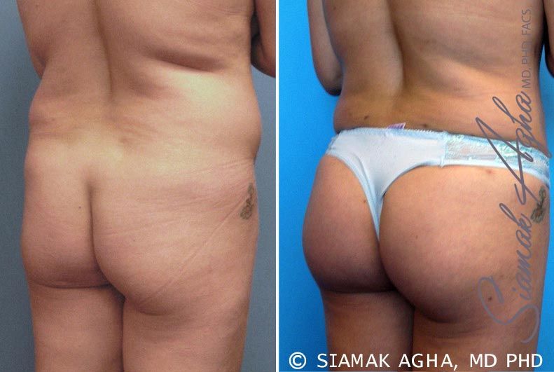 Brazilian Butt Lift Before & After