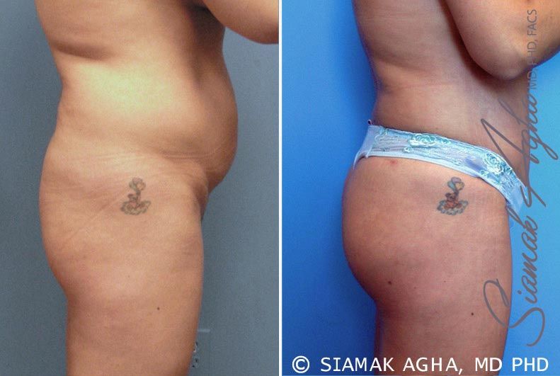 Brazilian Butt Lift Before & After