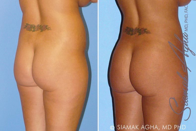 Brazilian Butt Lift Before & After