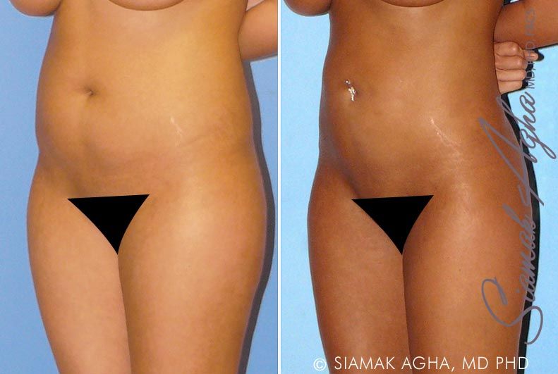 Brazilian Butt Lift Before & After