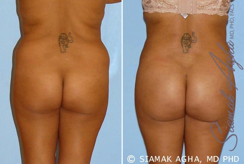 Brazilian Butt Lift Before & After