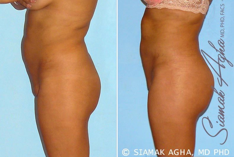 Brazilian Butt Lift Before & After