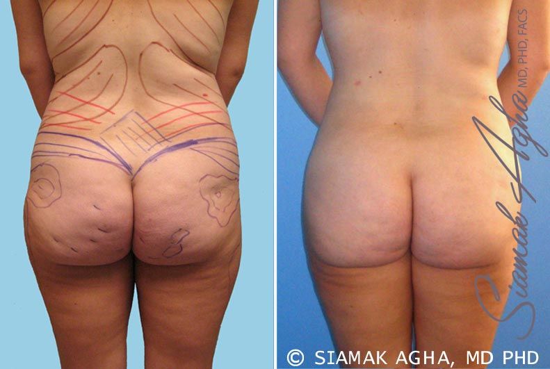 Brazilian Butt Lift Before & After