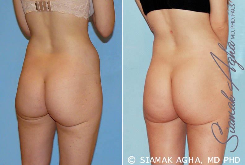 Brazilian Butt Lift Before & After