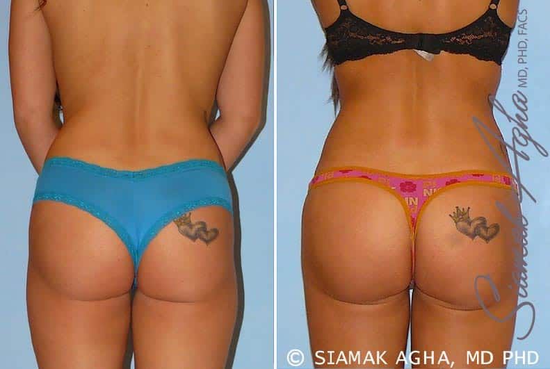 Brazilian Butt Lift Before & After