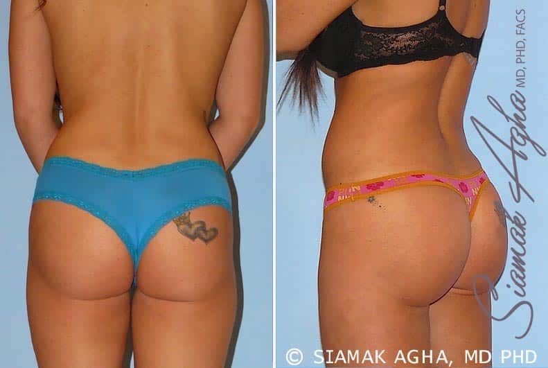 Brazilian Butt Lift Before & After