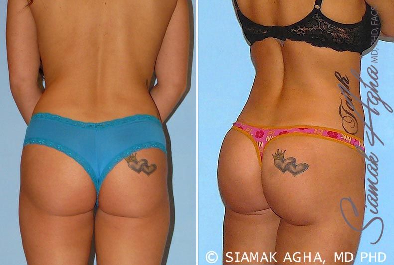 Brazilian Butt Lift Before & After