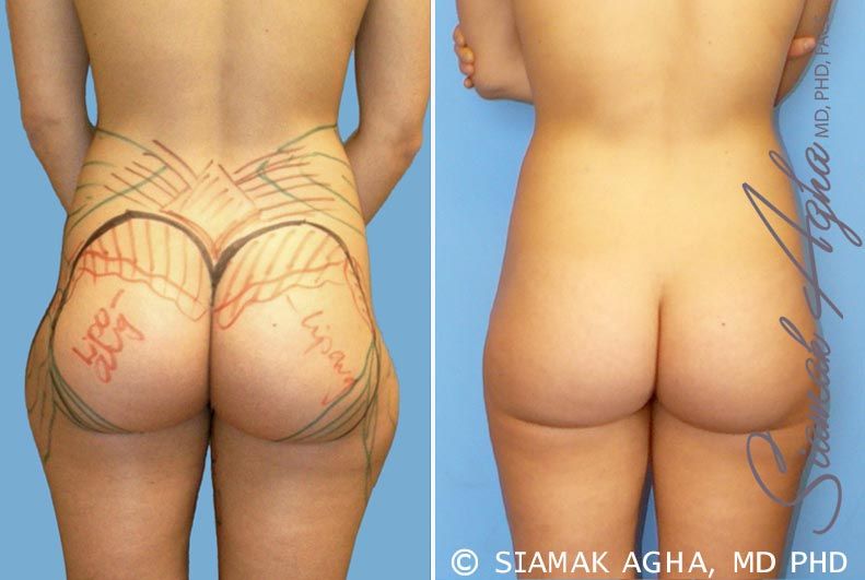 Brazilian Butt Lift Before & After