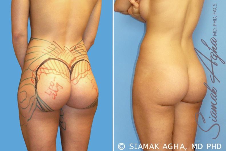 Brazilian Butt Lift Before & After