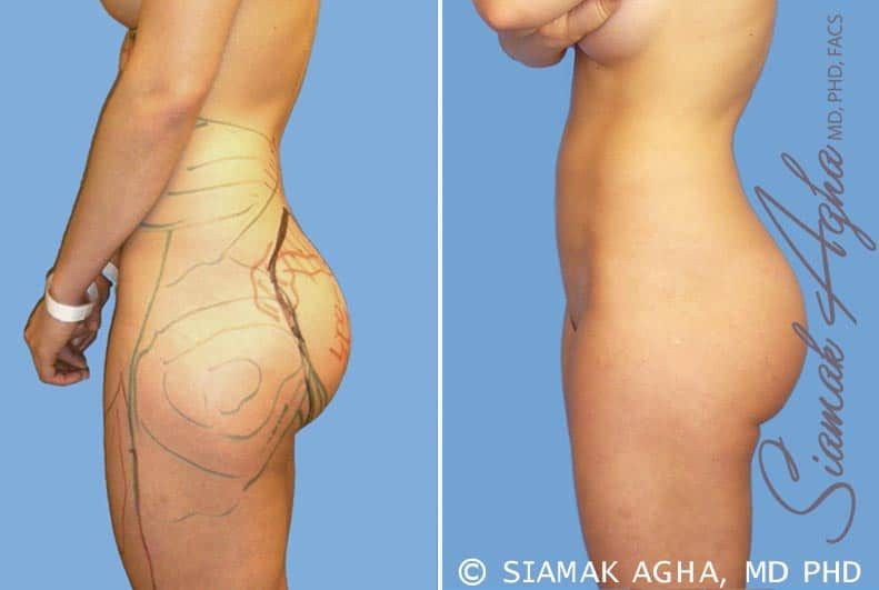 Brazilian Butt Lift Before & After