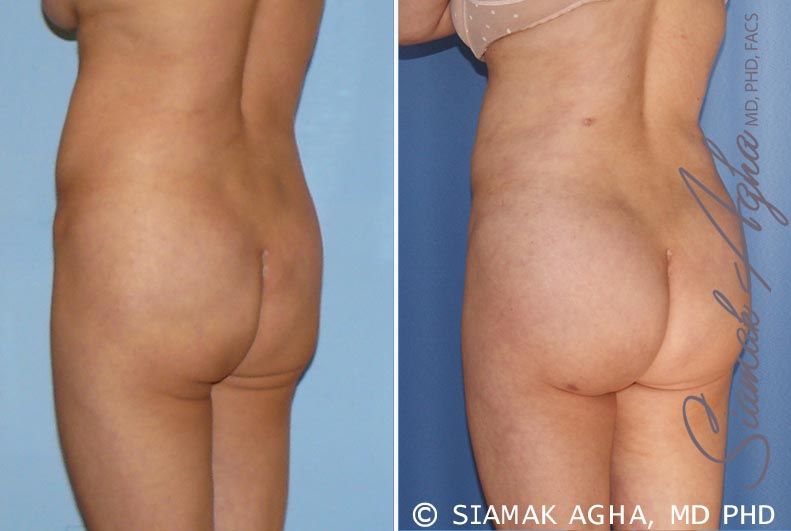 Brazilian Butt Lift Before & After