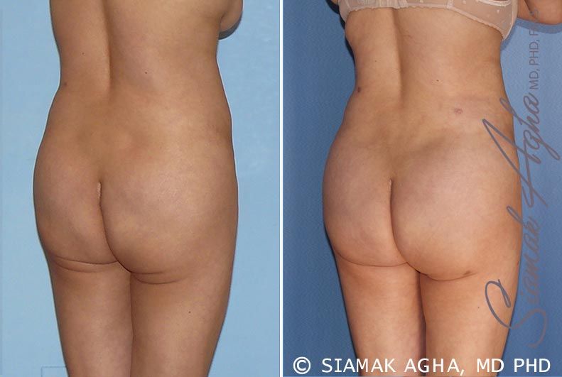 Brazilian Butt Lift Before & After