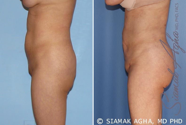 Brazilian Butt Lift Before & After