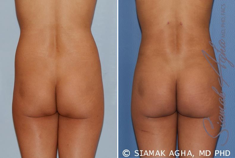 Brazilian Butt Lift Before & After