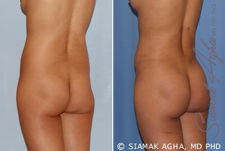 Brazilian Butt Lift Before & After