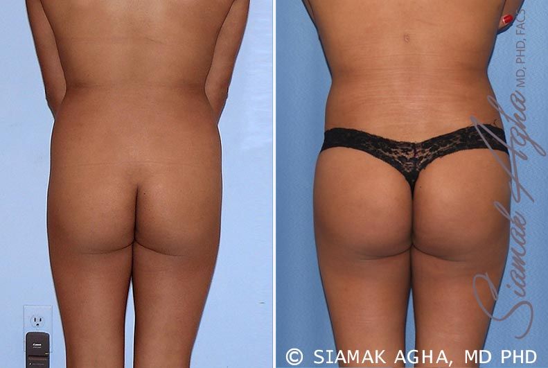 Brazilian Butt Lift Before & After