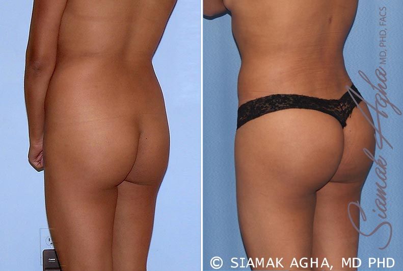 Brazilian Butt Lift Before & After