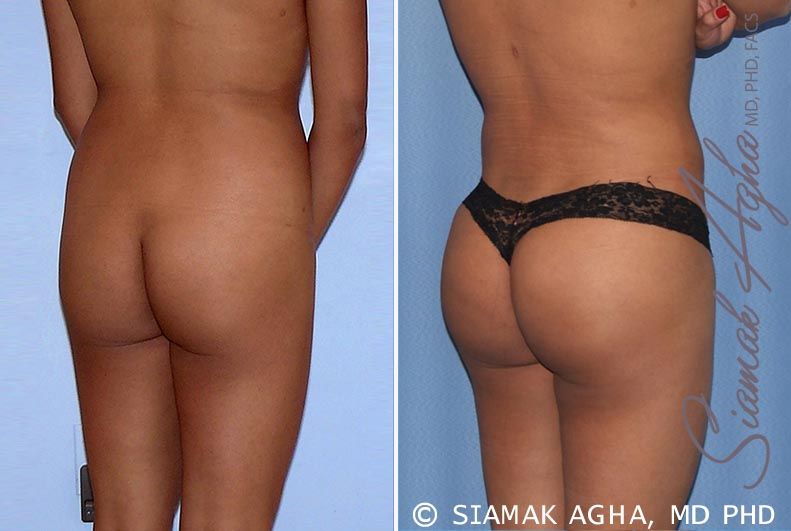 Brazilian Butt Lift Before & After