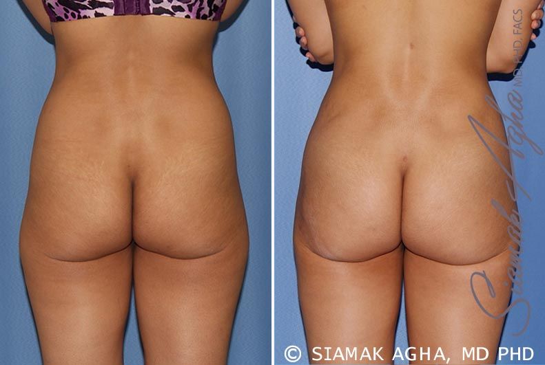 Brazilian Butt Lift Before & After