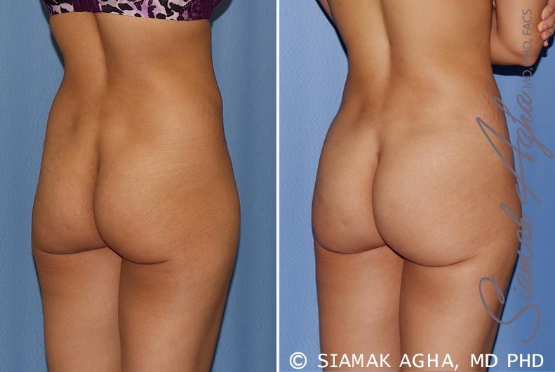 Brazilian Butt Lift Before & After