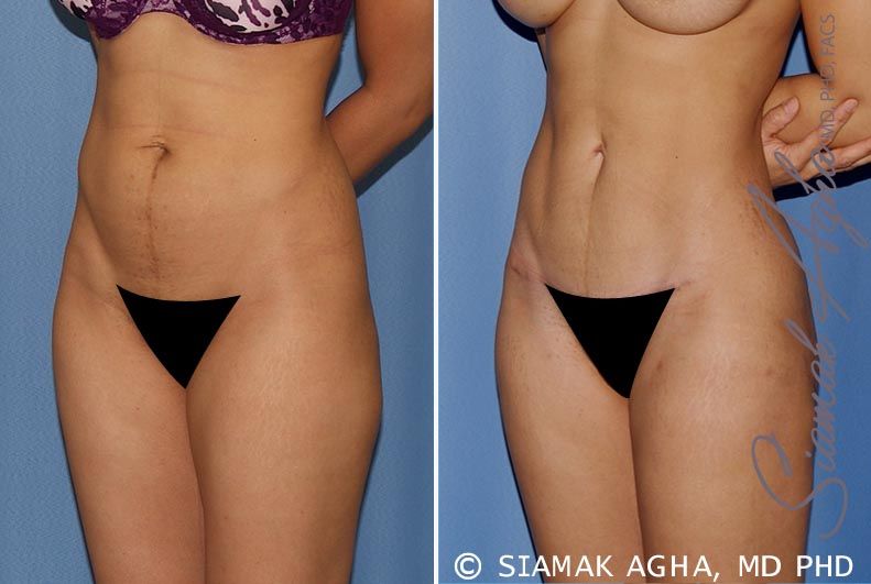 Brazilian Butt Lift Before & After