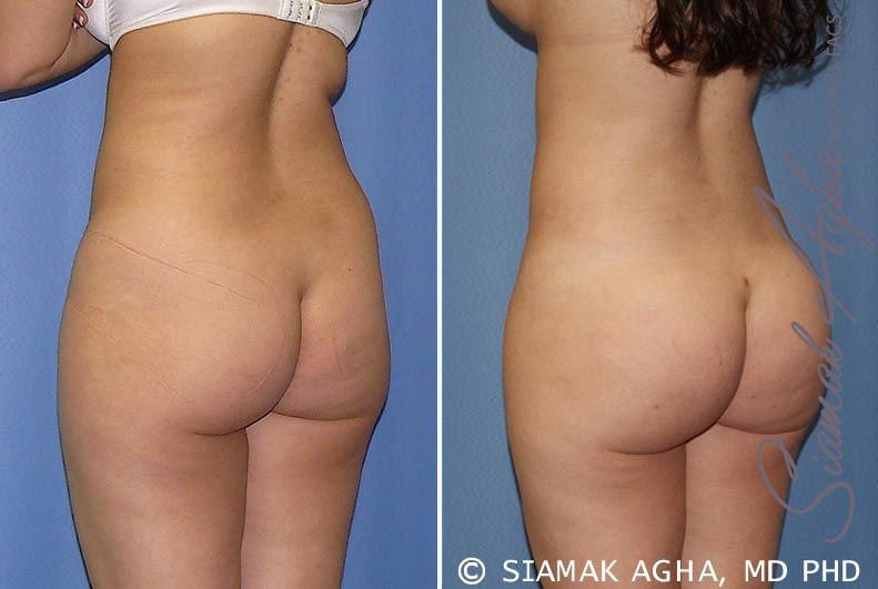 Brazilian Butt Lift Before & After