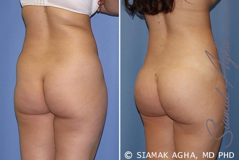 Brazilian Butt Lift Before & After