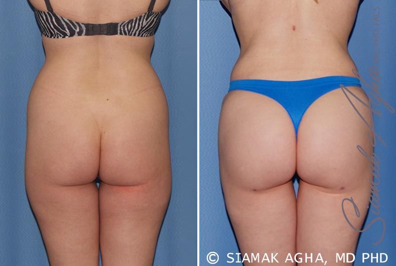 Brazilian Butt Lift Before & After