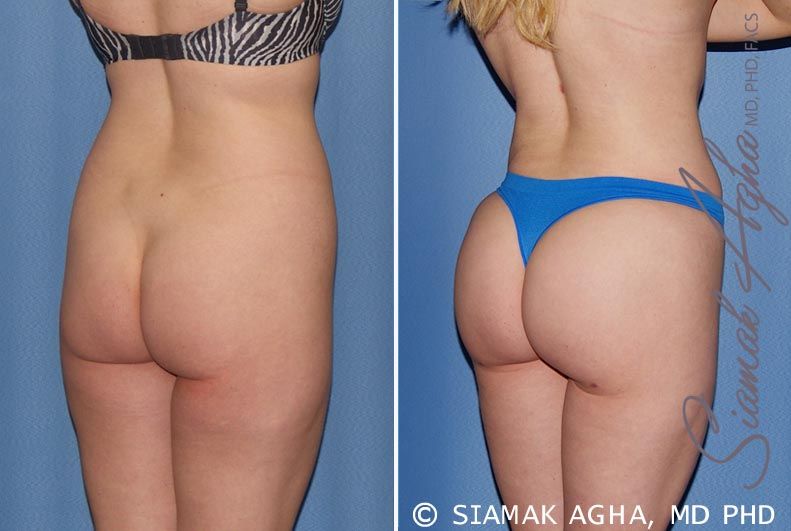 Brazilian Butt Lift Before & After